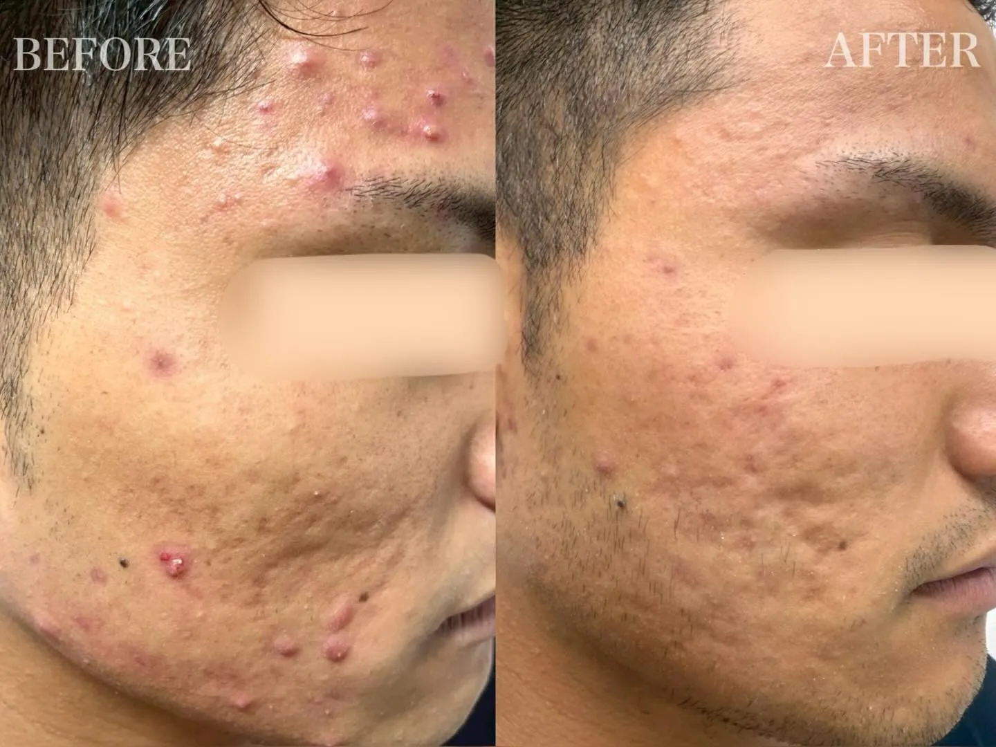 【 20代男性 / ニキビ、ニキビ跡 】